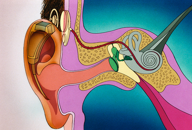 Кохлеарный имплантат — протез, позволяющий компенсировать потерю слуха людям с тяжелой степенью нейросенсорной тугоухости. Микрофон отправляет звуки на компьютер, имплантированный под кожу головы, электроды стимулируют слуховой нерв.
