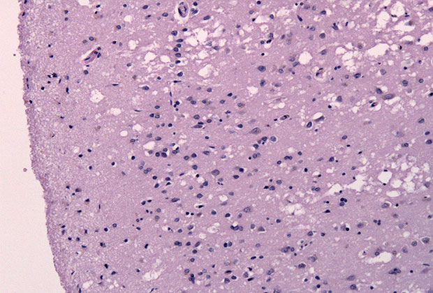 Ткани головного мозга пациента с болезнью Крейтцфельдта-Якоба