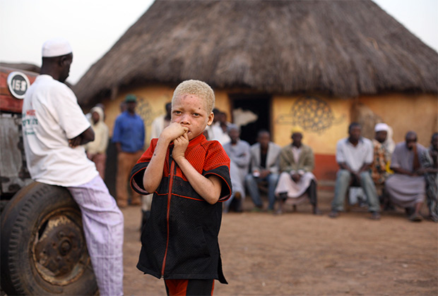 Как живется в Череповце ребенку-альбиносу
