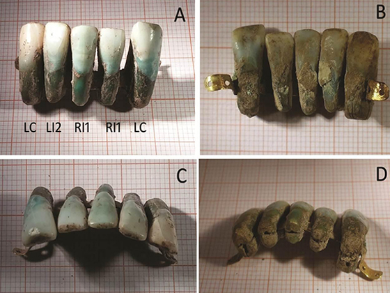 Средневековые европейские зубные протезы, Италия