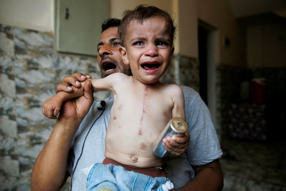 Ребенок со шрамом от операции на сердце. В руке у него остов от гранаты со слезоточивым газом, брошенной полицейскими
