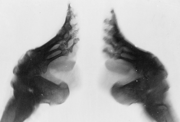 Рентген-снимок деформированной стопы