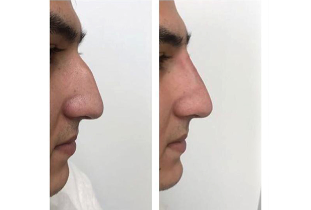Безоперационная коррекция носа: до процедуры и после