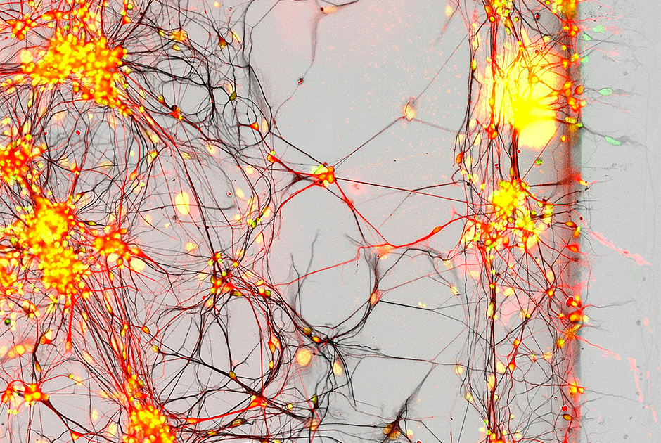 Человеческие нейроны в культуре клеток, выделенных у пациентов с болезнью Паркинсона. Соннам, Южная Корея.