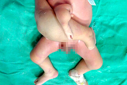Младенцу отрезали четыре лишние конечности