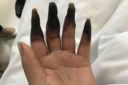 После уборки у китаянки почернели восемь пальцев