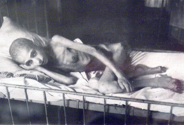 Жертва «ленинградской болезни» — алиментарной дистрофии