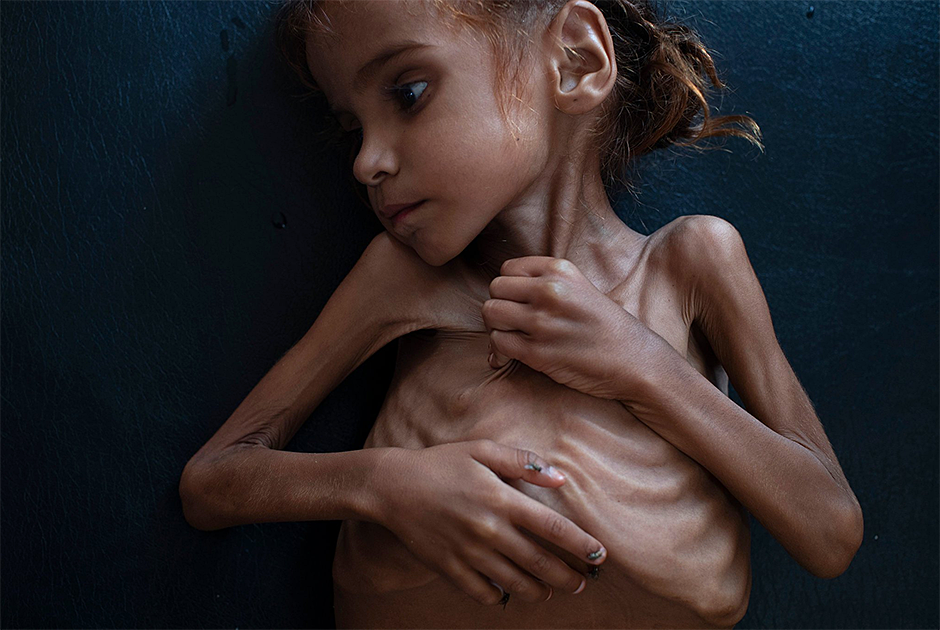 Семилетняя Амаль Хусейн из Йемена страдала от тяжелой острой недостаточности питания. Медики оказались бессильны: девочка умерла 26 октября 2018 года, спустя три дня после выписки из клиники ЮНИСЕФ. Снимок, сделанный за пять дней до ее гибели, занял второе место в категории «Мировые новости».