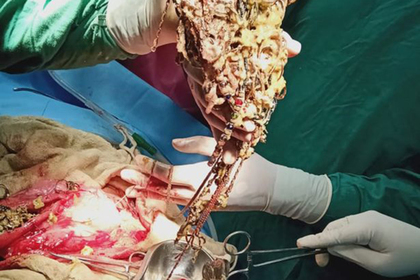 Хирург нашел в желудке пациентки драгоценный клад