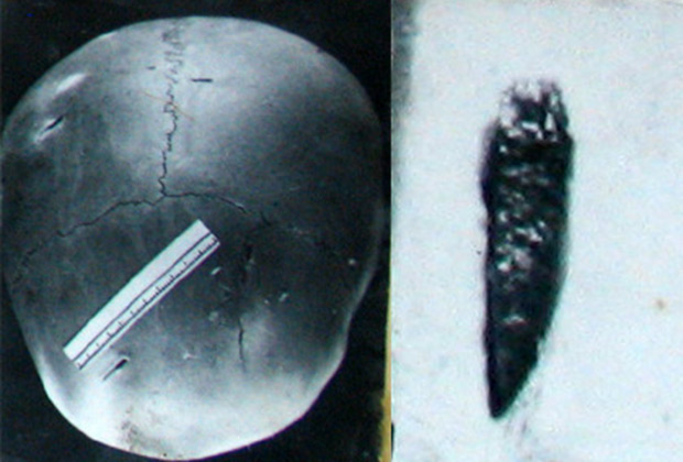 Череп Герты Грибановой и извлеченный фрагмент ножа