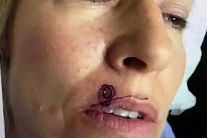 Небольшое пятно над губой женщины оказалось признаком смертельной болезни