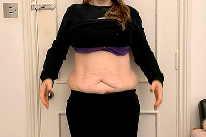 Женщина похудела на 70 килограммов и пожалела