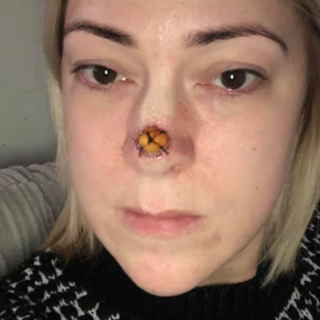 Рана на носу после фурункула — вопрос №14554