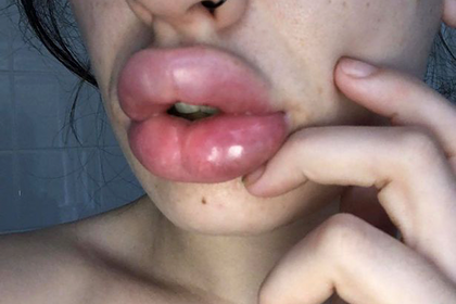 Малые половые губы - причины, симптомы, диагностика, лечение и профилактика