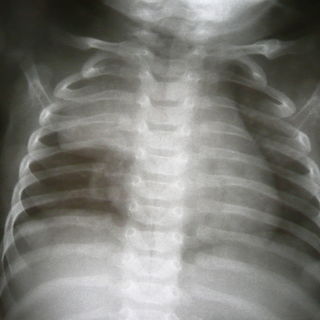 Вилочковая железа на рентгенограмме