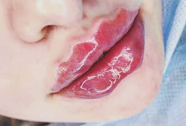 Причины тонких губ