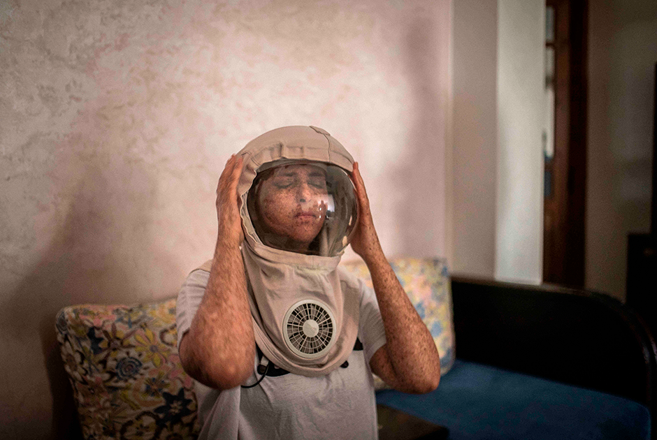 27-летняя жительница Марокко Фатимазехра Эль-Газауи страдает редким заболеванием под названием ксеодерма пигментная, известным также как прогрессирующий меланоз. При этом наследственном заболевании кожи чувствительность к ультрафиолетовому облучению усиливается и прогрессирует, поэтому всякий раз перед выходом на улицу девушке приходится надевать специальную защитную маску. 

