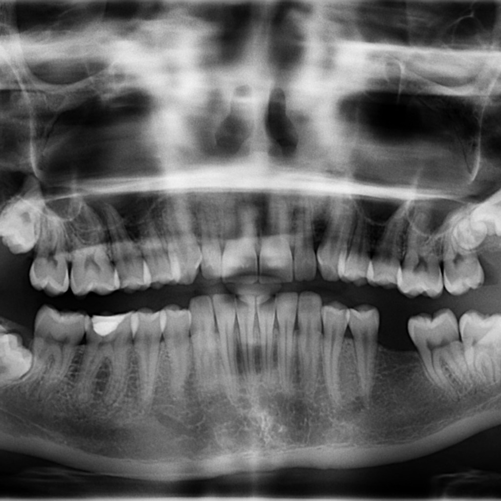 Ортопантомограмма челюсти