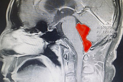 Мужчина десять лет страдал от головной боли из-за червя в мозге