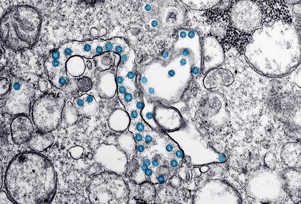 Сферические частицы нового коронавируса (на фото окрашены в синий цвет)