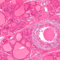 Гранулема при подостром тиреоидите (микрофотография)