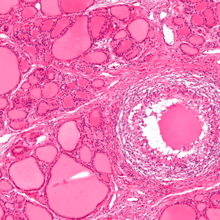 Гранулема при подостром тиреоидите (микрофотография)
