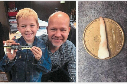 Стоматолог вырвал у мальчика самый длинный в истории молочный зуб