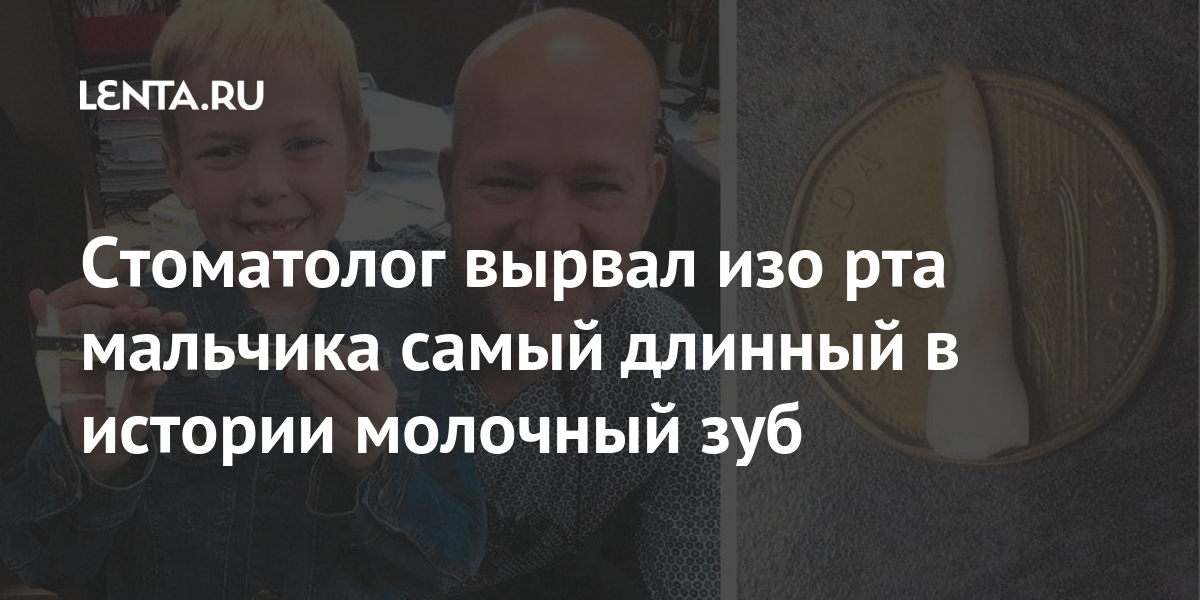 Стоматолог вырвал изо рта мальчика самый длинный в истории молочный зуб 1 share a9c37579d7d7b523e4513f8819e1cb7b Стоматолог вырвал изо рта мальчика самый длинный в истории молочный зуб