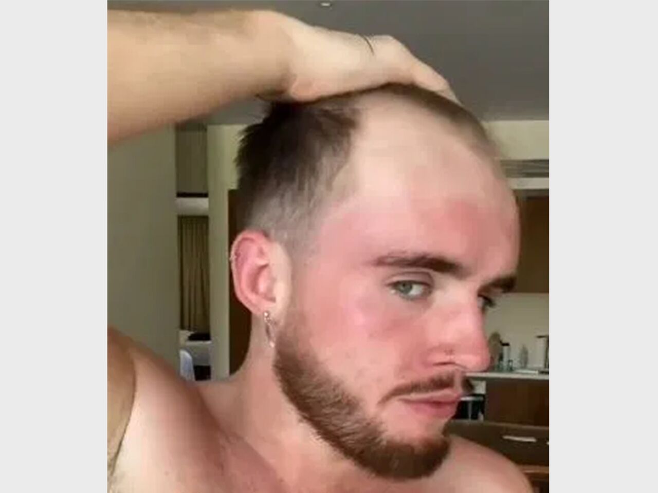 Пересадка волос на лоб