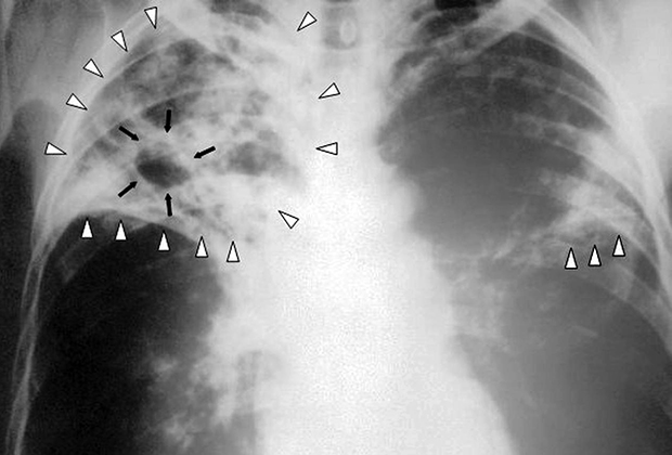 Поражение легких при туберкулезе
