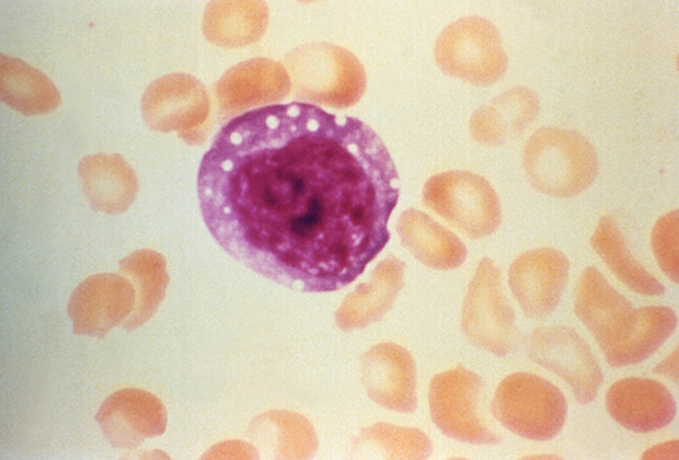 Подкрашенный лимфоцит, окруженный эритроцитами