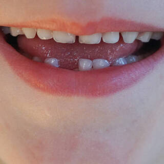 Зачем проводят серебрение молочных зубов?