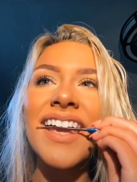 Подтачивание зубов с помощью пилки