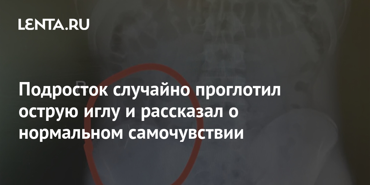 КУСОК В ГОРЛЕ: ЧТО ДЕЛАТЬ ЕСЛИ ЧЕЛОВЕК ПОДАВИЛСЯ ИЛИ ПРОГЛОТИЛ НЕСЪЕДОБНЫЙ ПРЕДМЕТ