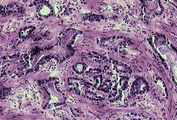 Клетки рака предстательной железы. Фото: National Institutes of Health