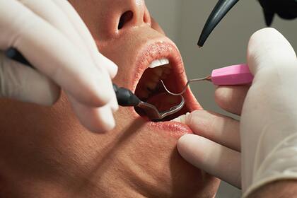 Стоматолог назвал способ не удалять зуб с кистой