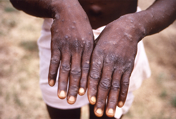 Руки пациента с обезьяньей оспой, Конго