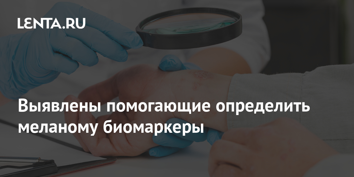 Выявлены помогающие определить меланому биомаркеры: Здоровье: Наука и ...