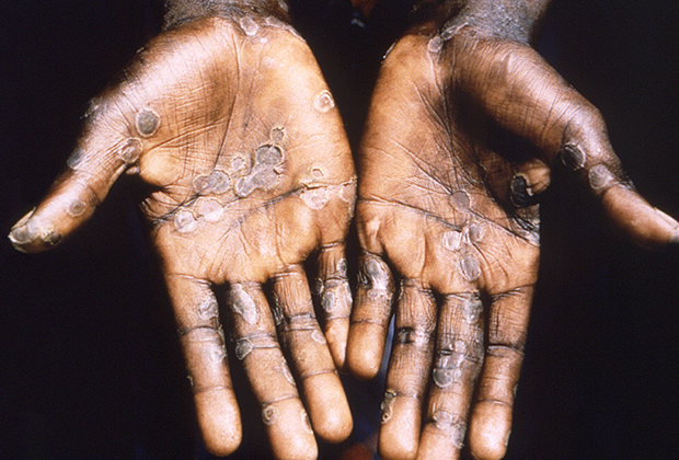 Руки пациента с оспой обезьян. Фото: Smith Collection / Gado / Getty Images