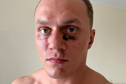 Блогер Тарасов показал лицо после поражения в кулачном бою техническим нокаутом
