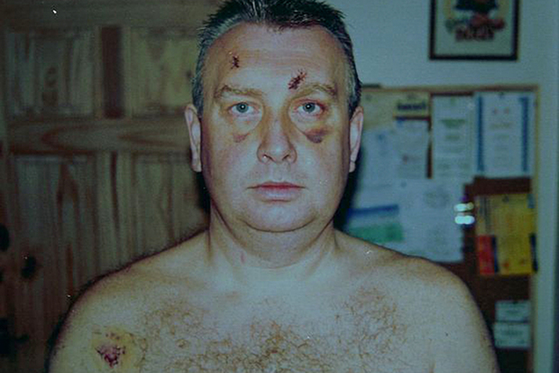 Ричард Томпсон после нападения Дины Томпсон. Фото: Mike Lavelle / Mirror