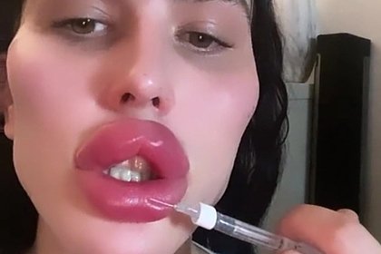 Увеличенные губы блогерши сравнили с вантузом в сети
