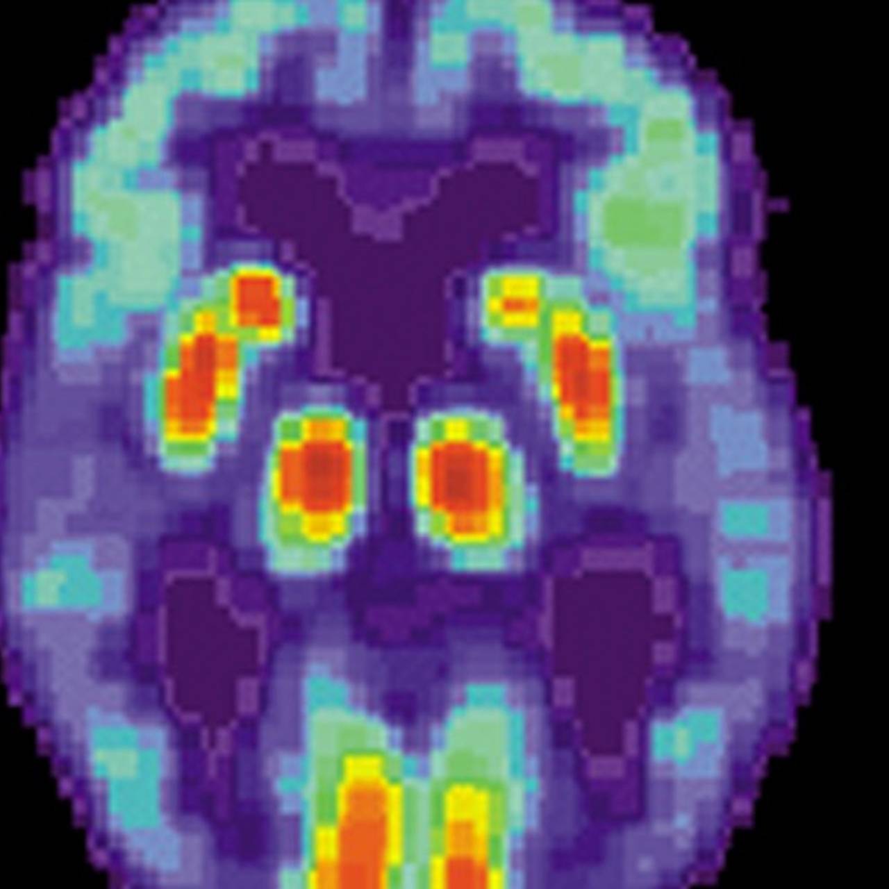 Phantom brain. ПЭТ кт при Альцгеймера. ПЭТ головного мозга. Pet сканирование при болезни Альцгеймера. Болезнь Альцгеймера на снимке мрт.