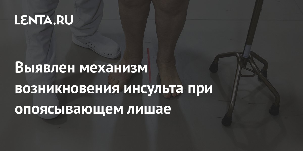 Выявлен механизм возникновения инсульта при опоясывающем лишае ...