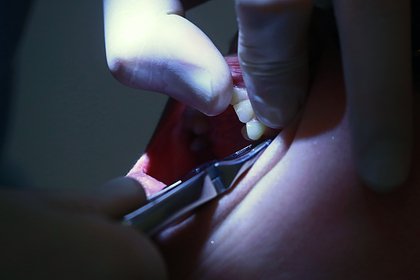 В Москве стоматолог просверлила первокласснице щеку