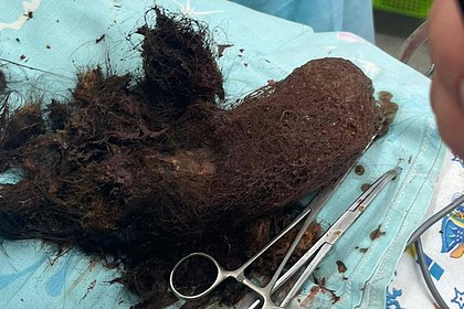 Российские врачи извлекли из живота 12-летней девочки 20-сантиметровый ком волос