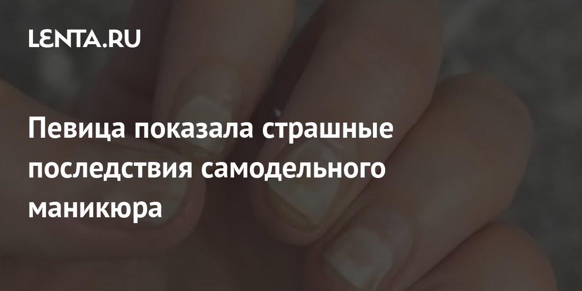 Певица показала страшные последствия самодельного маникюра: Внешний вид ...
