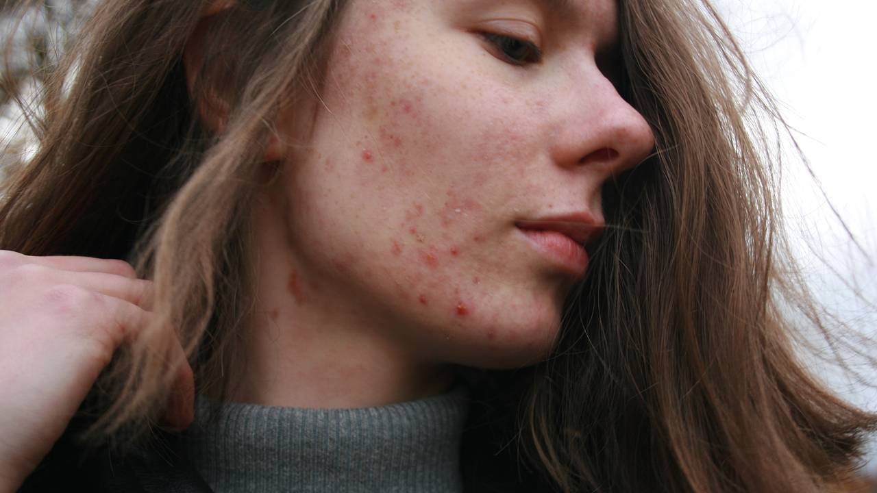 Acne as a sign of gastrointestinal diseases