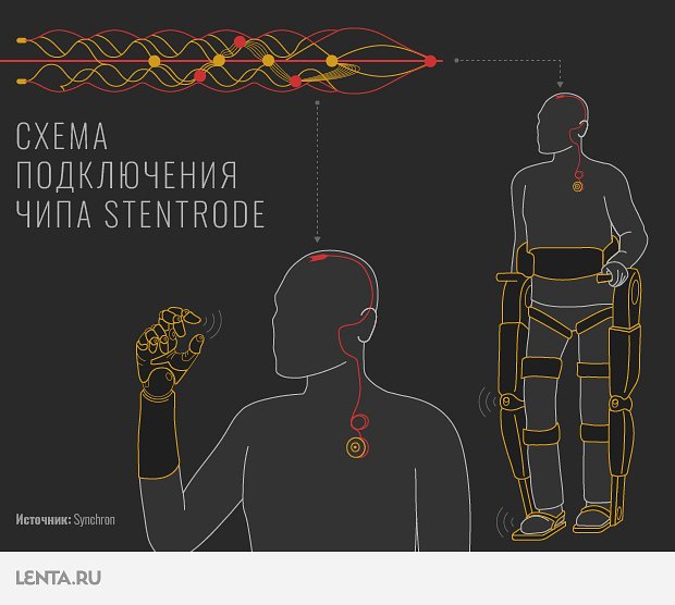 Чип Stentrode от компании Synchron