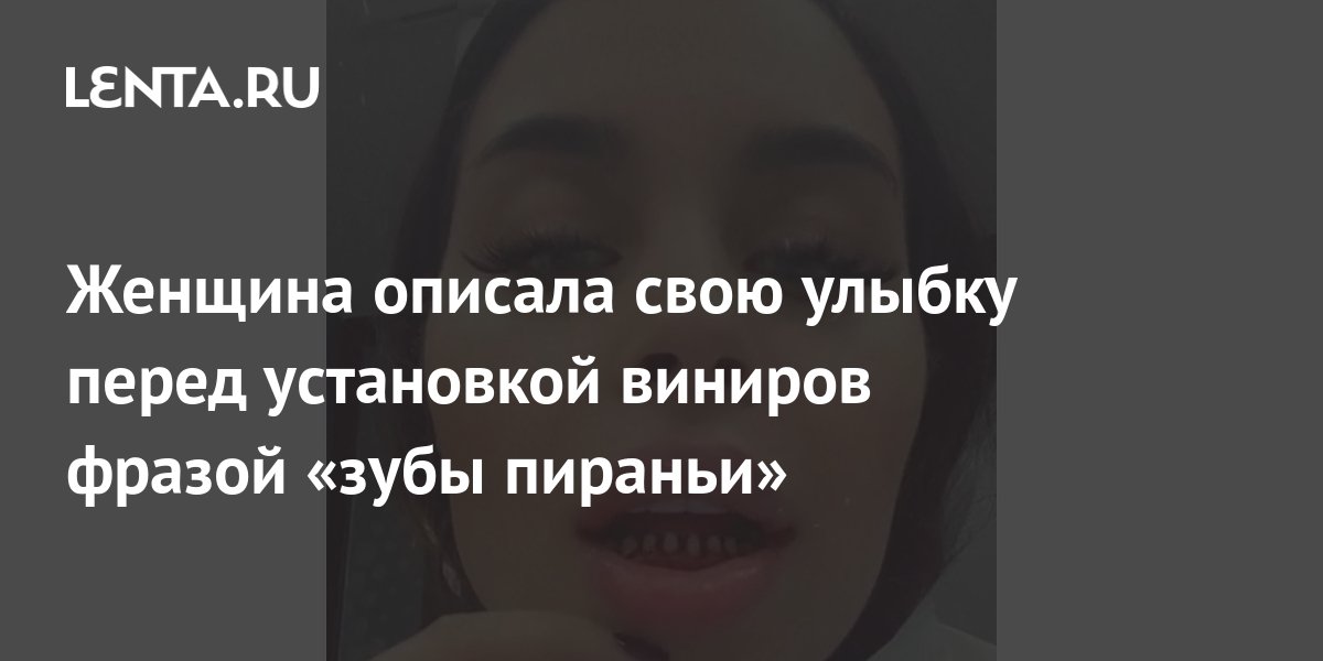 Женщина описала свою улыбку перед установкой виниров фразой «зубы ...